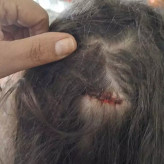 Menina de 7 anos é atingida na cabeça por bala perdida enquanto dormia em casa